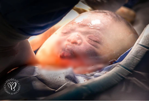 Em bé bĩu môi trong túi ối cách đây 2 năm, giờ kháu khỉnh, đáng yêu