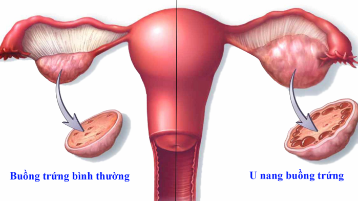 Mang khối u buồng trứng mẹ trẻ vẫn quyết có bầu: Sự đánh đổi nguy hiểm