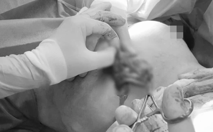 Người phụ bị biến chứng nâng ngực vì băng gạc để quên