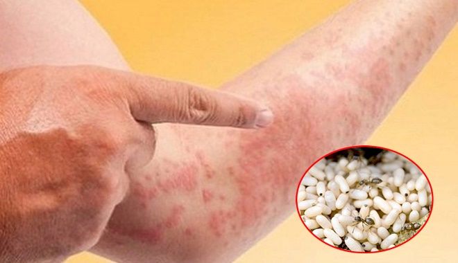 Thanh niên ăn trứng kiến toàn thân nổi mẩn, mắt sưng nề