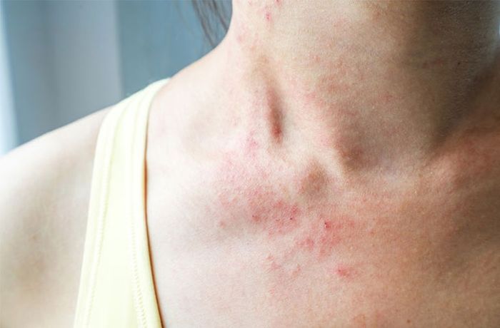 Bỏ túi những bí kíp để xử lý ngay các vấn đề thường gặp vào mùa hè