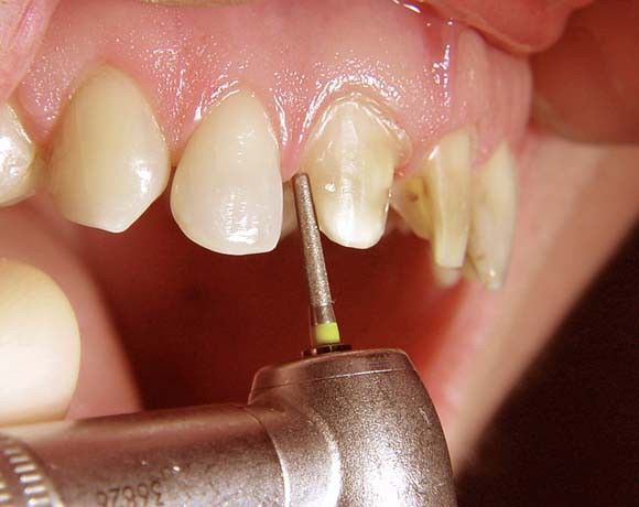 Răng bị hô, cô gái 26 tuổi đi bọc răng sứ kết quả mủn hết răng cửa