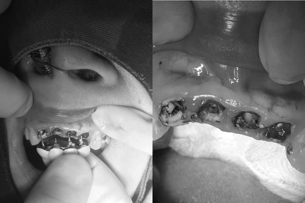 Răng bị hô, cô gái 26 tuổi đi bọc răng sứ kết quả mủn hết răng cửa