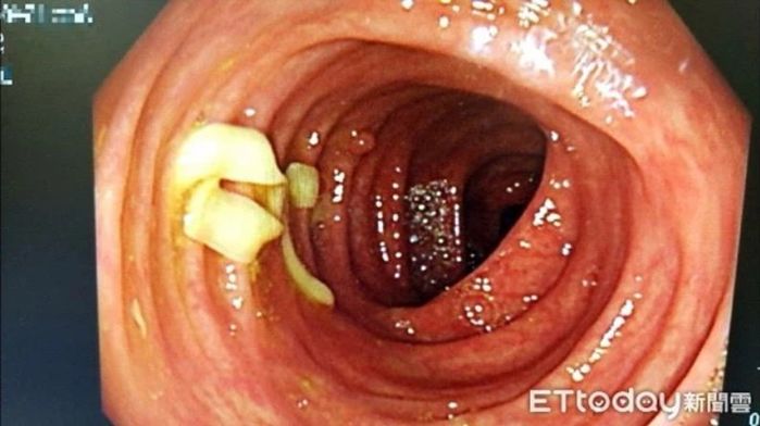 Chàng trai đau bụng vì hay ăn thịt bò tái, khiến sán làm tổ trong ruột