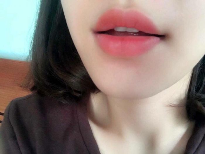Phun môi collagen, cô gái khóc ròng vì môi nứt nẻ, chảy máu đen xì