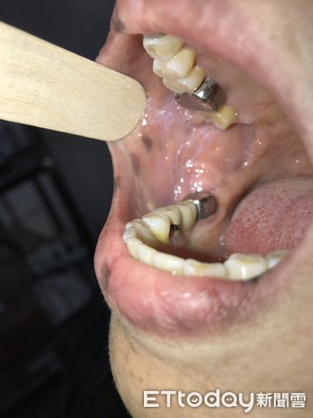 Nhiều tàn nhang ở môi, tay người phụ nữ bị chẩn đoán nan y đại tràng