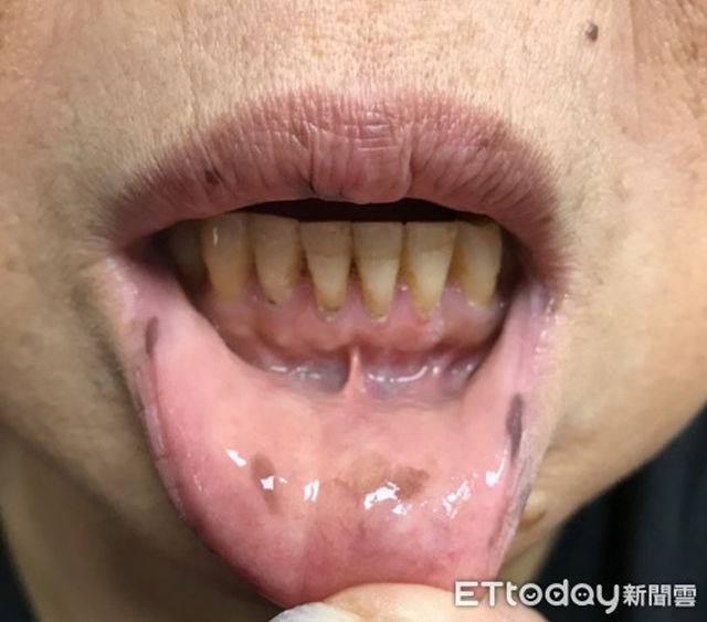 Nhiều tàn nhang ở môi, tay người phụ nữ bị chẩn đoán nan y đại tràng