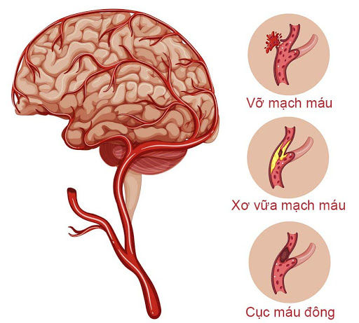 Dấu hiệu 1 mềm 1 cứng cảnh báo nguy cơ cơn xuất huyết não sắp đến