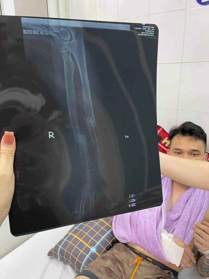 Khắc Việt gãy tay hủy show hàng loạt