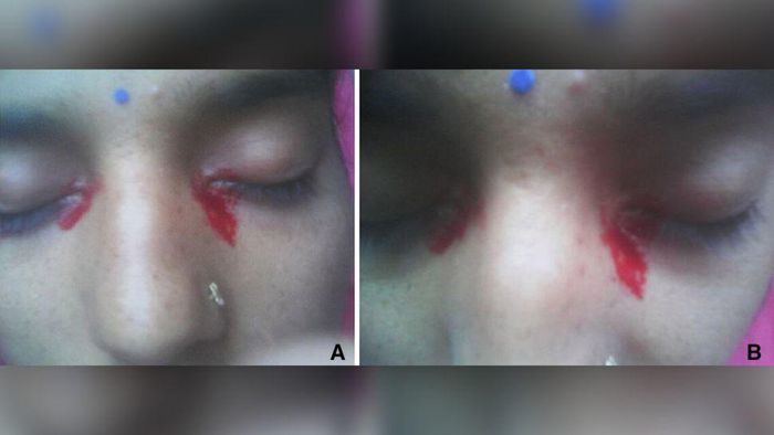 Kỳ lạ cô gái 25 tuổi cứ đến tháng là khóc ra máu