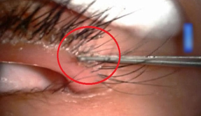Người phụ nữ 62 tuổi bị rận ký sinh trên mi mắt đẻ hàng chục quả trứng