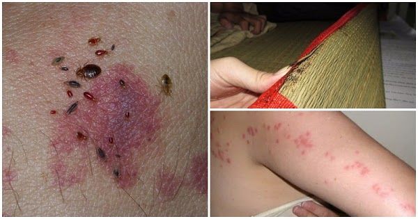 Người phụ nữ suýt nhiễm trùng máu vì rệp giường cắn