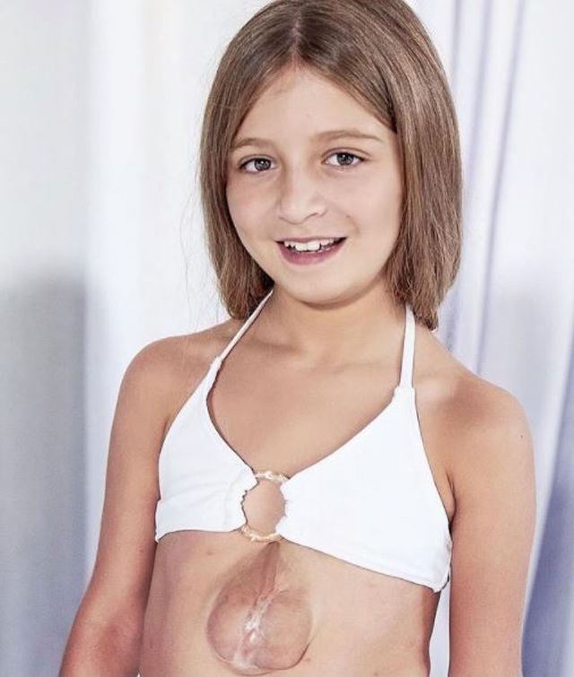 Bé gái sinh ra với trái tim ngoài lồng ngực 11 năm trước giờ ra sao?