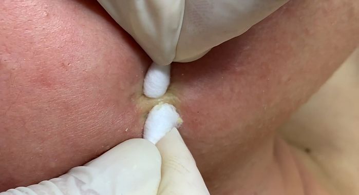 Clip nặn mụn vừa xem vừa nổi da gà, cớ sao nhiều người vẫn nghiện?