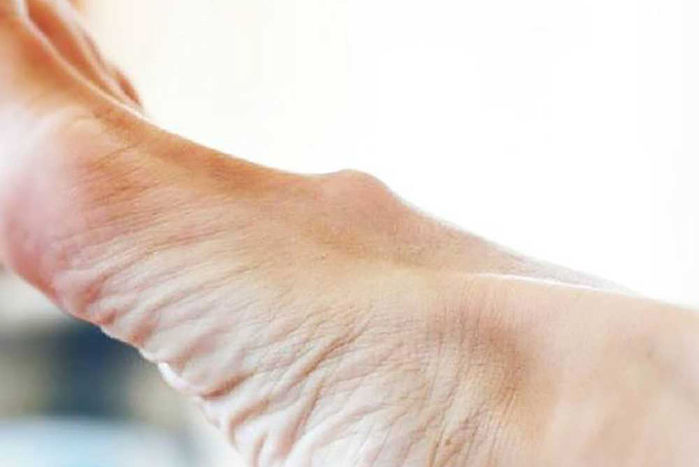 4 biểu hiện ở bàn chân cho thấy tế bào nan y đã nhắm tới bạn