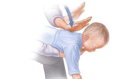 Cấp cứu bé 6 tháng tuổi hóc xúc xích tắc đường thở: Bố mẹ đừng lơ là