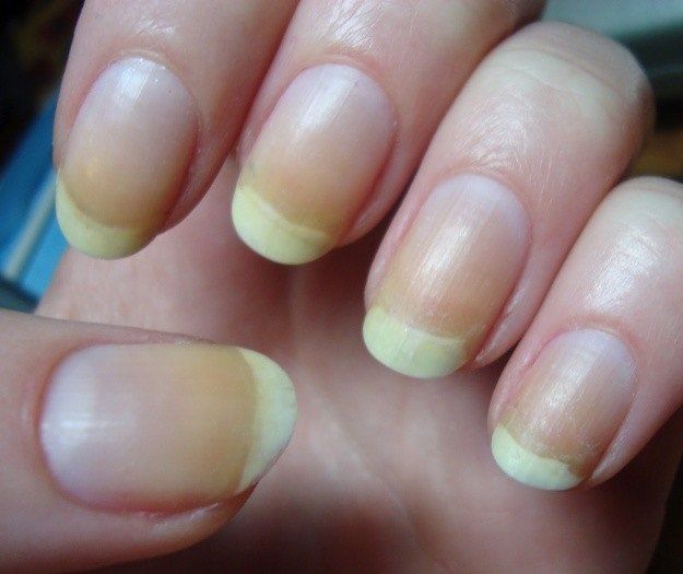 Gan xấu thì bàn tay sẽ xuất hiện 3 vấn đề: Nhất là màu sắc móng