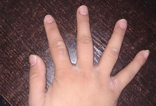 Gan xấu thì bàn tay sẽ xuất hiện 3 vấn đề: Nhất là màu sắc móng