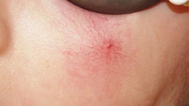 Gan xấu thì bàn tay sẽ xuất hiện 3 vấn đề: Nhất là màu sắc móng