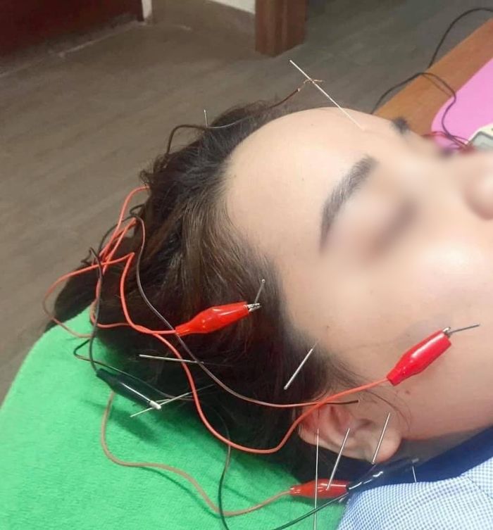 Mất ngủ vì stress kéo dài, cô gái 26 tuổi bị điếc vĩnh viễn 1 bên tai