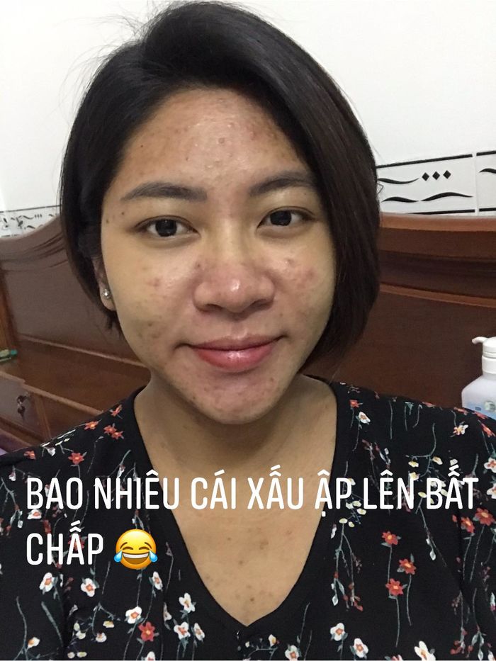 Mỹ nhân Việt tan nát khi mang bầu: Đặng Thu Thảo mụn chi chít