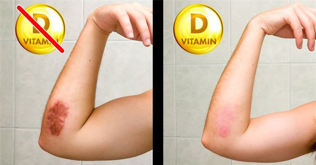 8 dấu hiệu của cơ thể nhắc cần bổ sung gấp vitamin D: Đổ mồ hôi nhiều