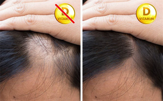 8 dấu hiệu của cơ thể nhắc cần bổ sung gấp vitamin D: Đổ mồ hôi nhiều