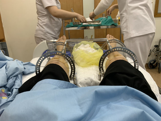 Cô gái giấu bố mẹ kéo chân sau 4 tháng: cao thêm 7cm, tự tin tạo dáng