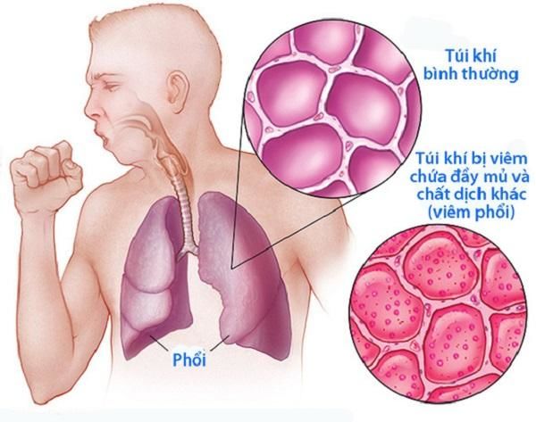 Người mẫu Đức Long qua đời vì viêm phổi, lưu ý triệu chứng khó thở