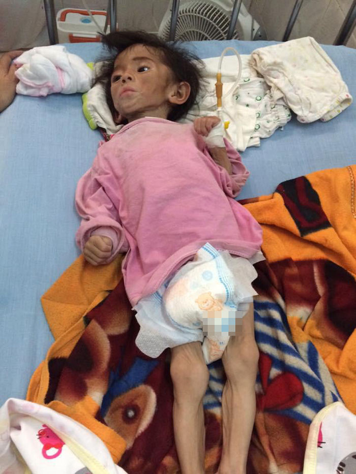 Hình ảnh em bé Lào Cai suy dinh dưỡng sau 5 năm được mẹ 9X nhận