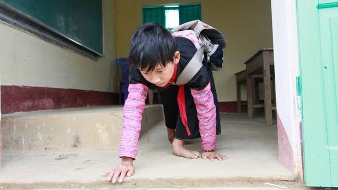 Cậu bé 8 tuổi đến trường bằng đôi tay rướm máu, mơ ước có đôi chân giả