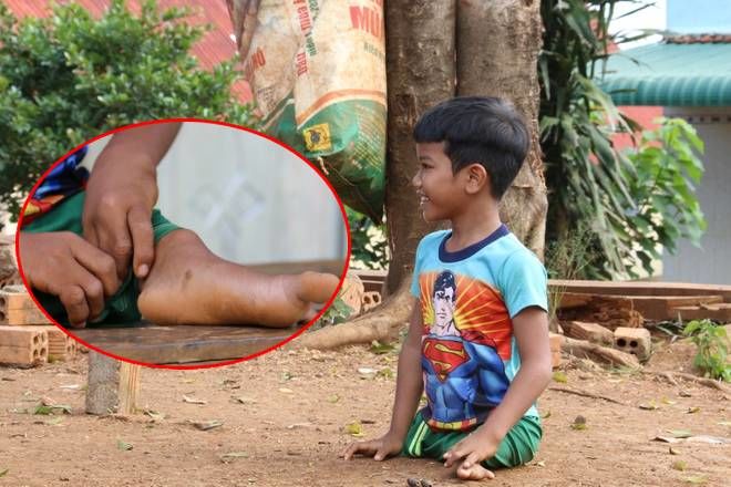 Cậu bé 8 tuổi đến trường bằng đôi tay rướm máu, mơ ước có đôi chân giả