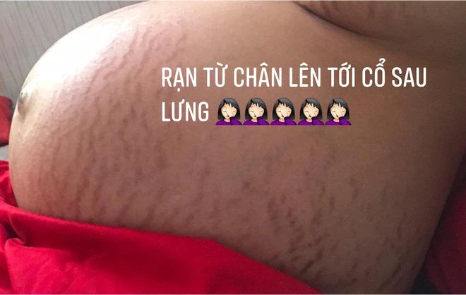 Nỗi niềm sao Việt khi sinh nở: Người phải lết đi, người mụn chi chít