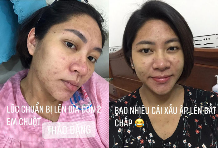 Nỗi niềm sao Việt khi sinh nở: Người phải lết đi, người mụn chi chít