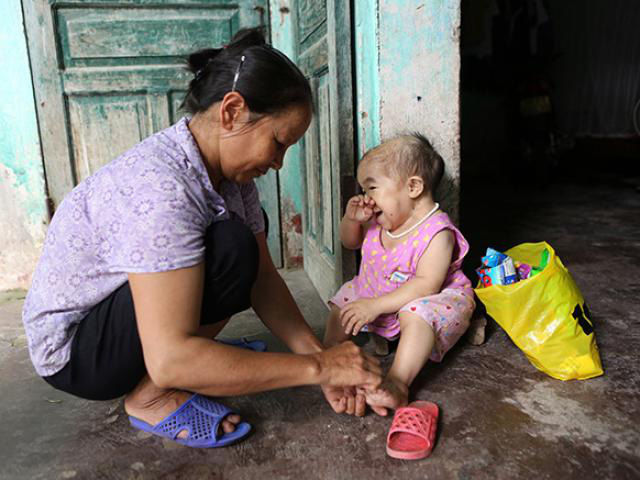 Mẹ già nuôi con gái không bao giờ lớn: 31 năm vẫn hình hài 1 đứa trẻ