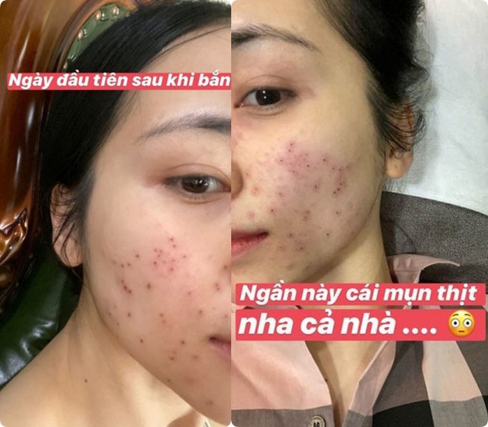 Hòa Minzy và mỹ nhân Việt truyền kinh nghiệm xử lý dứt điểm mụn thịt
