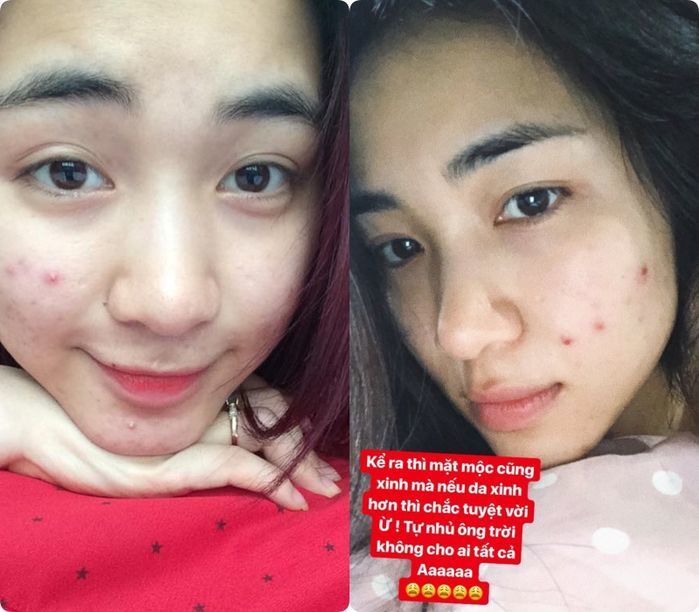 Hòa Minzy và mỹ nhân Việt truyền kinh nghiệm xử lý dứt điểm mụn thịt