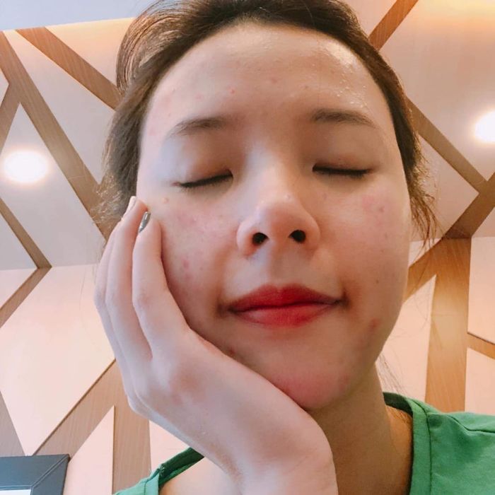 Hòa Minzy và mỹ nhân Việt truyền kinh nghiệm xử lý dứt điểm mụn thịt