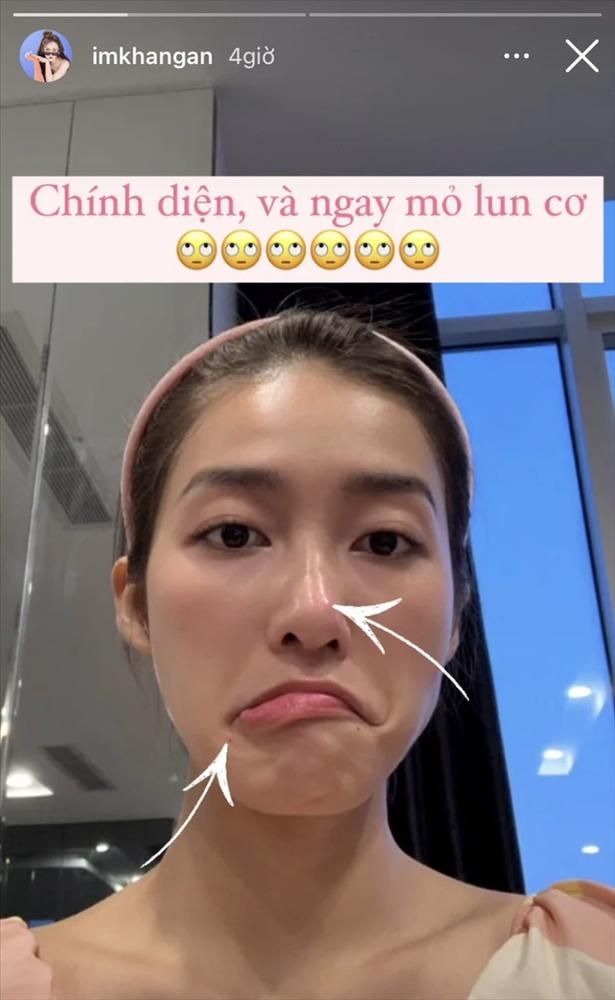 Hòa Minzy và mỹ nhân Việt truyền kinh nghiệm xử lý dứt điểm mụn thịt