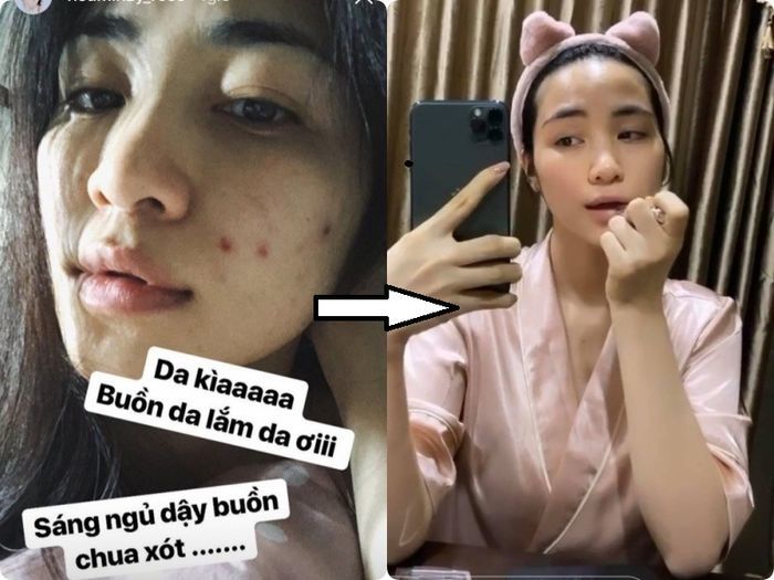 Hòa Minzy và mỹ nhân Việt truyền kinh nghiệm xử lý dứt điểm mụn thịt