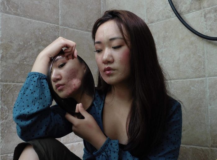 Cô gái bị mụn từ năm 12 tuổi: Cảm giác mọi người nhìn vào da mình