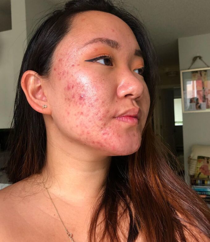Cô gái bị mụn từ năm 12 tuổi: Cảm giác mọi người nhìn vào da mình