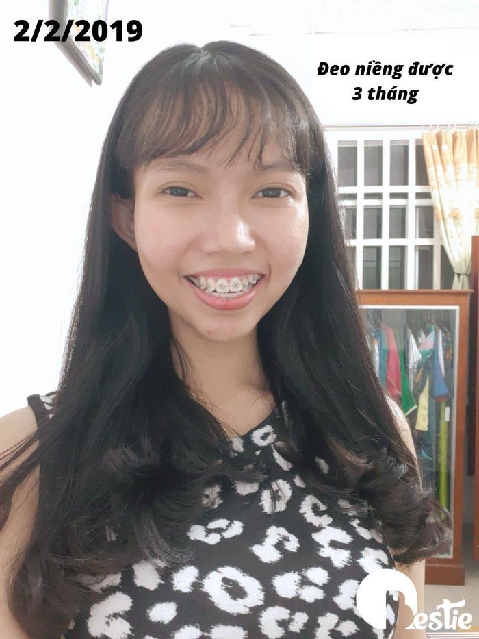 Chi 30 triệu niềng răng và 40 triệu mổ cận, cô gái lột xác ngoạn mục