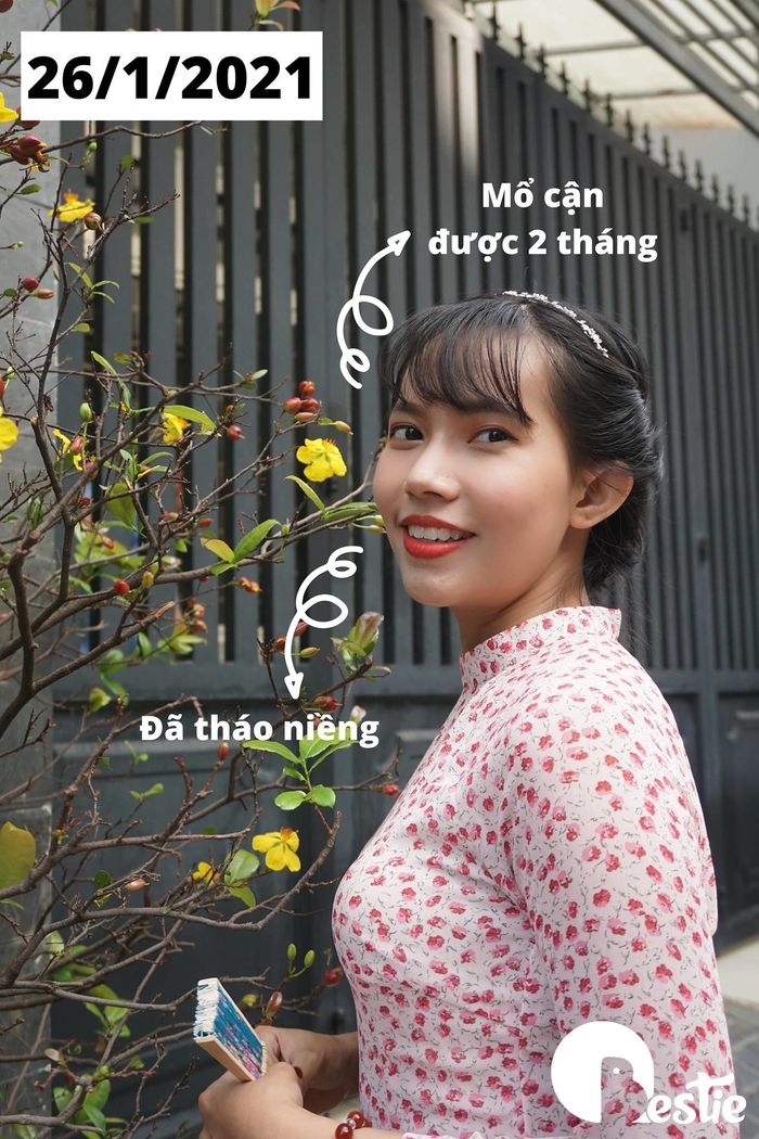 Chi 30 triệu niềng răng và 40 triệu mổ cận, cô gái lột xác ngoạn mục