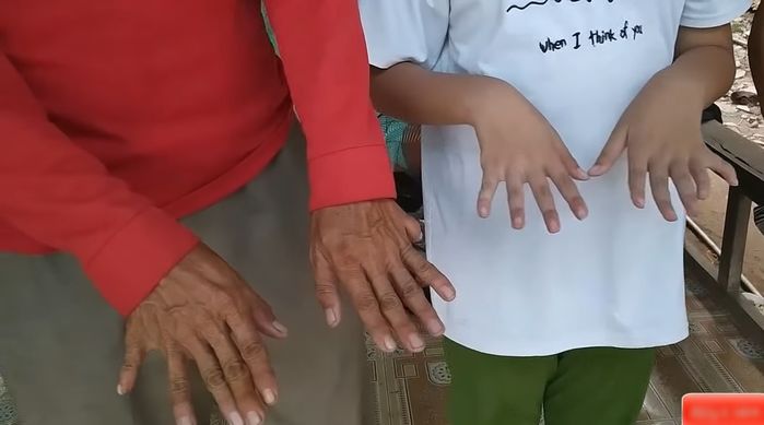 Gia đình 3 đời có 24 ngón tay, chân, tất cả đều bình thường