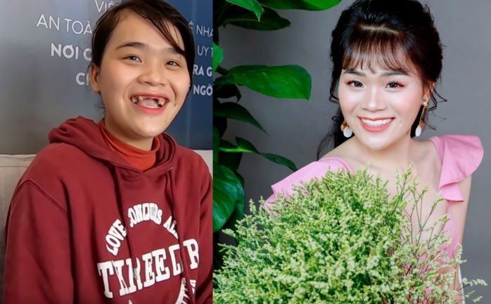 Thánh sún Ngân Thảo: Rụng 9 cái răng chồng không chê, đi thi cho vui