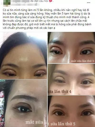 Cô gái cắt mí ăn tết hoảng hồn vì 1 ngày rồi không nhắm mắt được