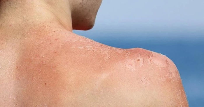5 dấu hiệu kiệt sức của làn da dưới nắng nóng và cách khắc phục