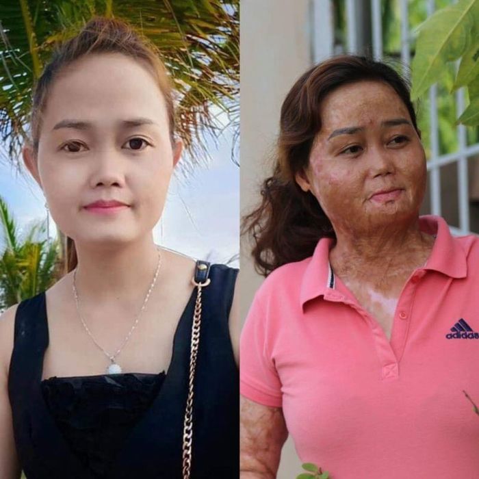 Vượt qua nỗi đau thể xác, bà mẹ hai con tìm được tình yêu đích thực