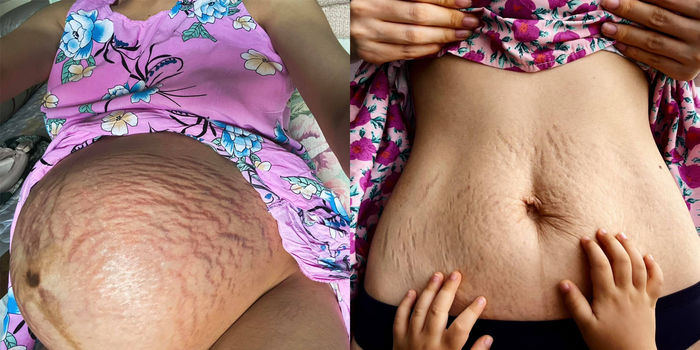 Hội những bà mẹ Vbiz tự tin khoe vết rạn: Bất ngờ với Trương Mỹ Nhân